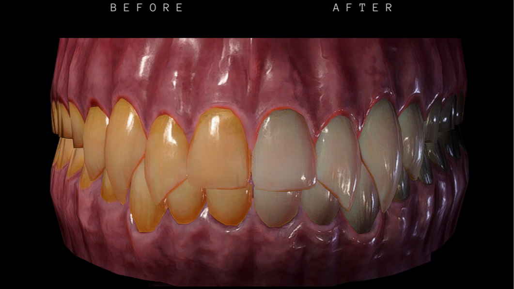 刷牙 – 更亮的牙齿 (BrushYourTeeth – Brighter Teeth)